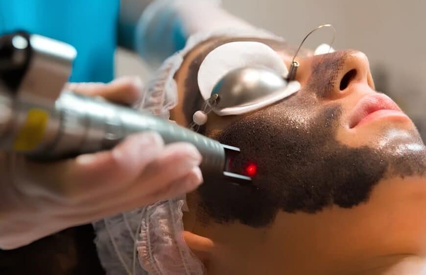 Hollywood Peel (Carbono Activo)